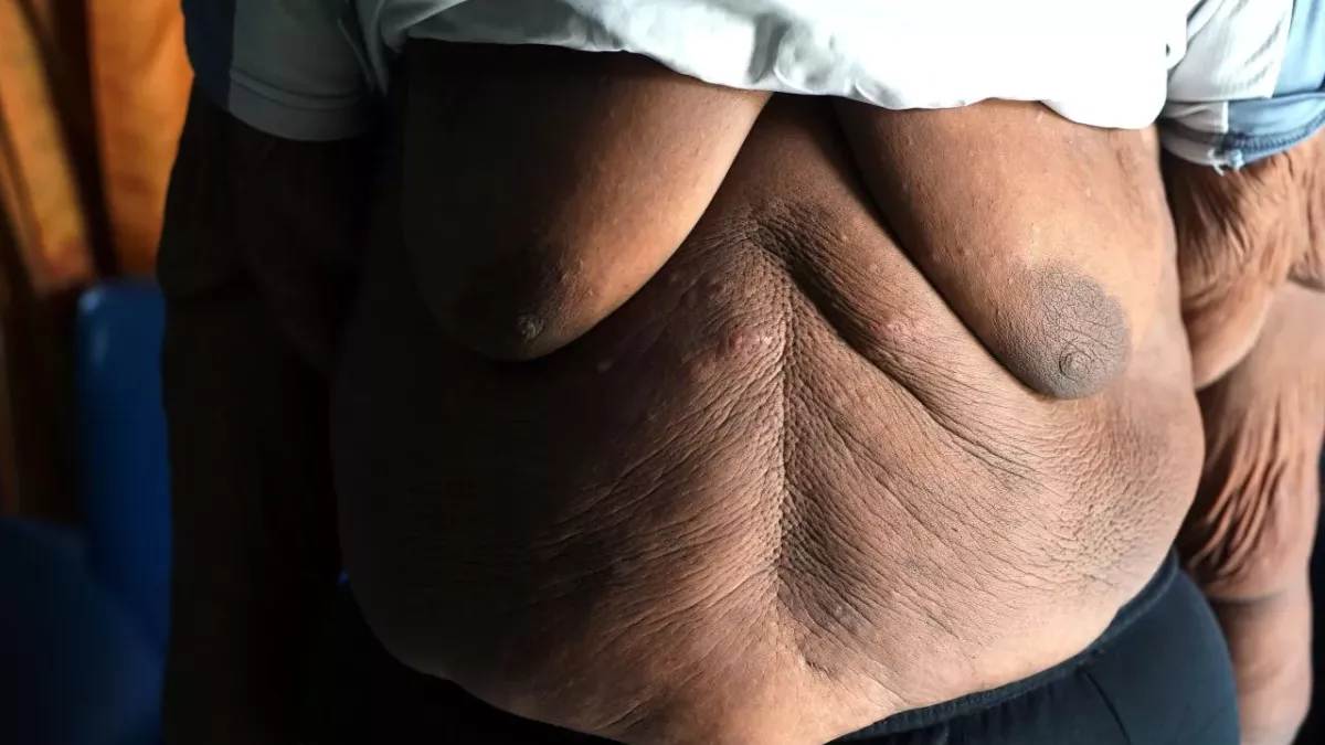 Un Youtubeur en situation d'obésité morbide arrête de manger pendant 150 jours pour sauver sa vie 