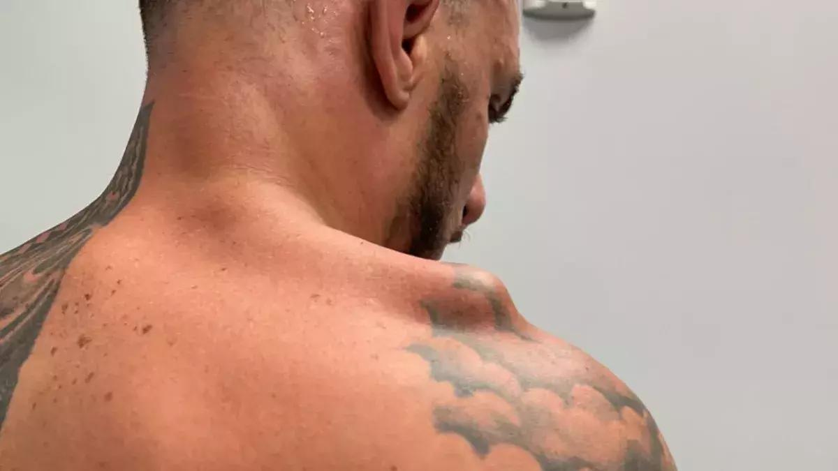 Blessure à l'épaule de Renato Moicano