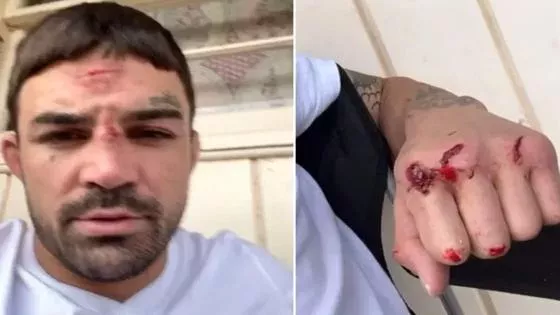 Tête ensanglantée, phalanges brisées, Mike Perry va quand même combattre le week-end prochain