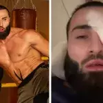 IbraTV s'est gravement blessé à l'oeil avant ses débuts en MMA.