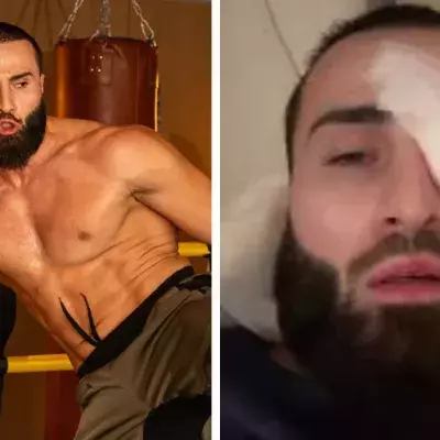 IbraTV s'est gravement blessé à l'oeil avant ses débuts en MMA.