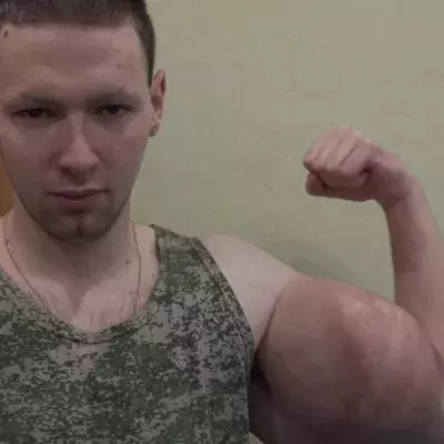 Synthol Kid : le Popeye russe aux bras musclés opéré une deuxième fois, il montre les images 