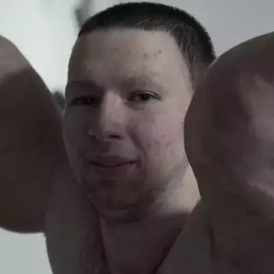 Synthol Kid :  Les terribles effets secondaires chez le fou qui s'injectait du Synthol pour avoir des bras à la Popeye