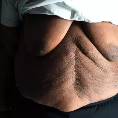 Un Youtubeur en situation d'obésité morbide arrête de manger pendant 150 jours pour sauver sa vie 