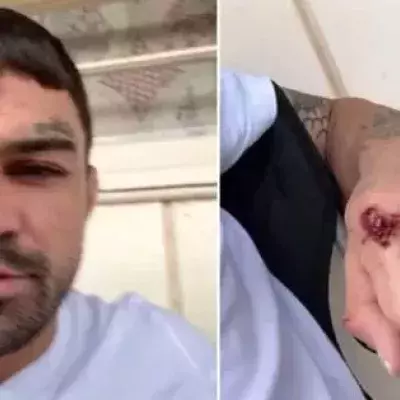 Tête ensanglantée, phalanges brisées, Mike Perry va quand même combattre le week-end prochain
